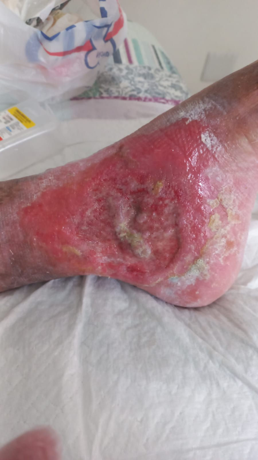 Úlcera Venosa - ANTES