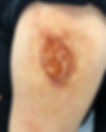 Ulcer