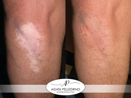 Dermopigmentazione Correttiva Vitiligine