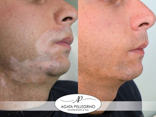 Dermopigmentazione Correttiva Vitiligine