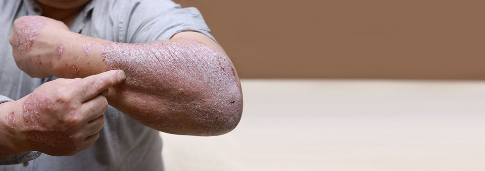 banner-acute-form-of-psoriasis-skin-male-showing-2023-04-25-02-22-59-utc_edited.jpg