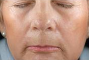 Full Face (After)