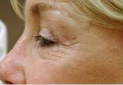 Eye Contour (Before)