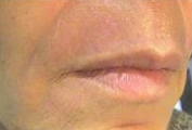 Upper Lip (After)