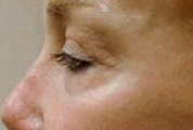 Eye Contour (After)