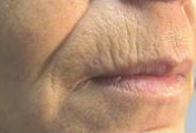 Upper Lip (Before)