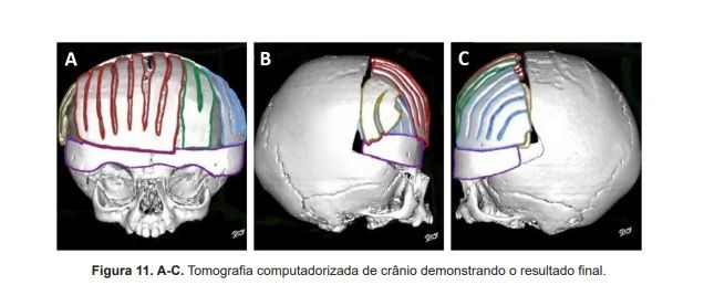 Braquicefalia: craniotomia em quatro peças