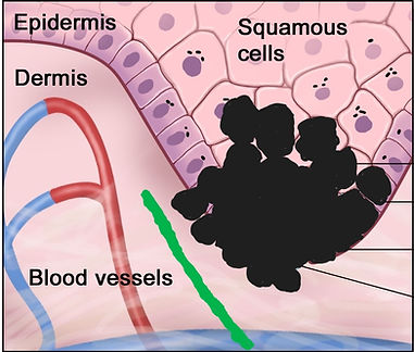 2 Mélanome débutant docteursales.be.jpg