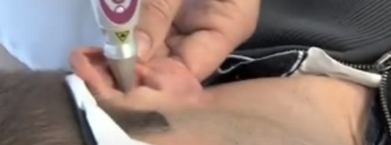 Auriculothérapie, traitement au laser