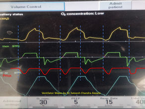 Look-Alikes: Failed Trigger vs Early Cycling