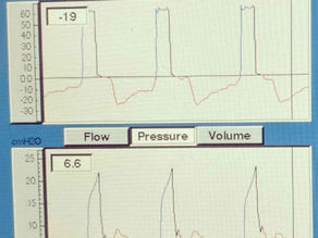 When the Breath Ends Too Soon: Early Cycling