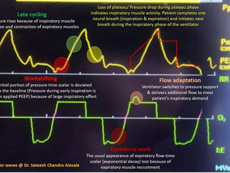 Multiple Dyssynchronies in a Single Waveform