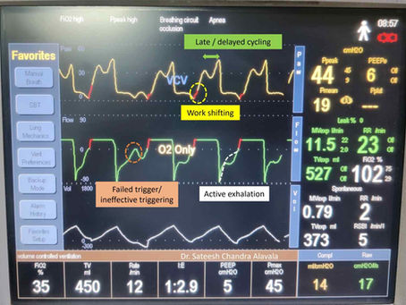 Consequences of Improper Ventilator Settings