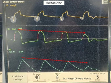 Cheyne Stokes Breathing