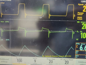 Endotracheal Tube Block
