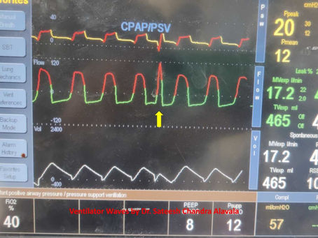 Recognizing Hiccups on Ventilator Waveforms