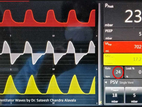 When the Heart Tricks the Ventilator
