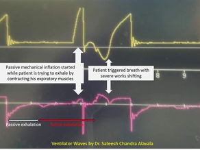 Out of Sync: Ventilator Inflating the Lung as the Patient Exhales