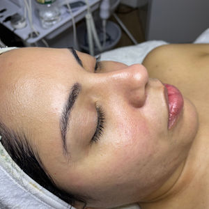 Acne Treatment