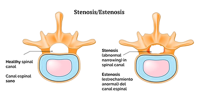 stenosis bil.png