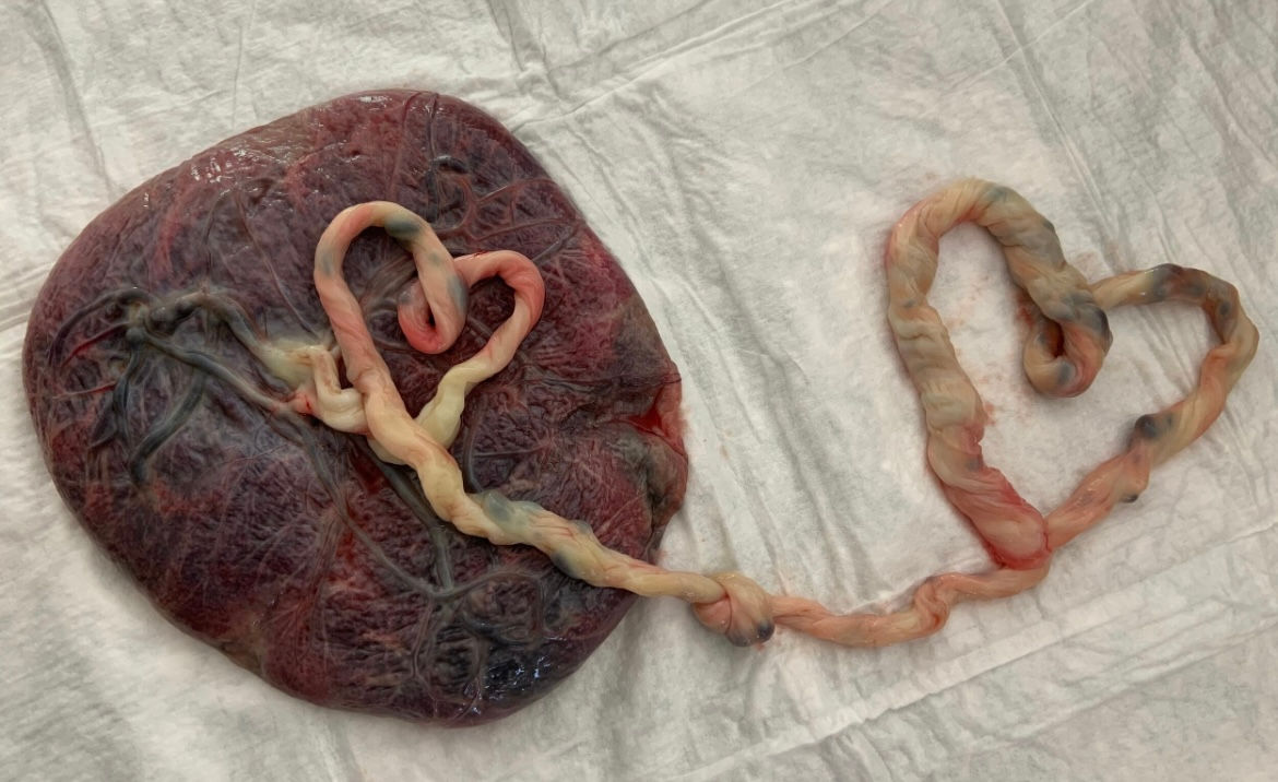 Placenta Encapsulation