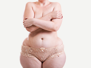 Lipödem - Vanessa's Schicksal und wie Du damit umgehen kannst