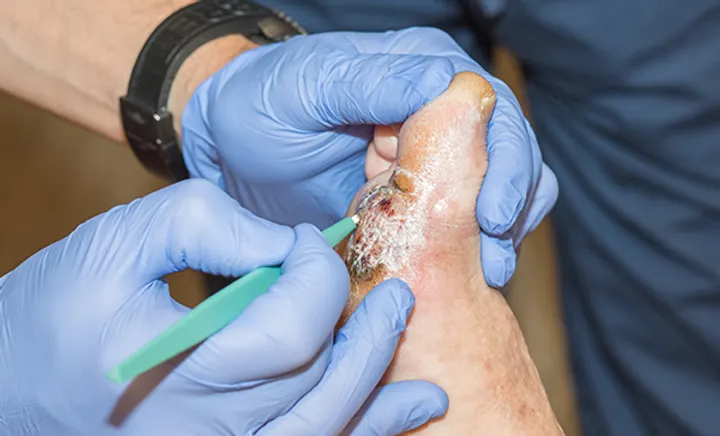 Debridement.jpg.webp