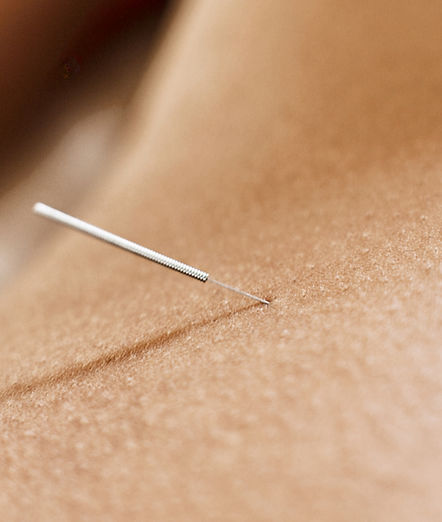 Woman Receiving Acupuncture_edited_edited.jpg