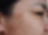 solar keratosis.jpg