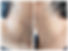 skin tag achrocordon.jpg