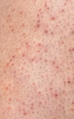 Strawberry_legs (1).webp