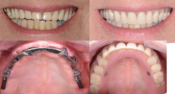 Reno Denture Cases