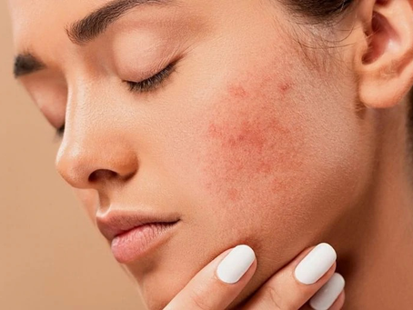 HOW TO DIMINISH STRETCH MARKS + ACNE SCARRING