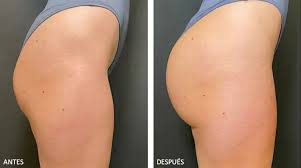 Bioplastia corporal con ácido poli-L-láctico