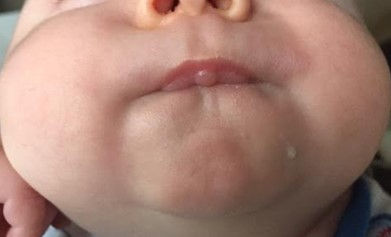 Figure 1. Infant showing over-development of the depressor labii inferioris and mentalis muscles from excessive use of the lower lip during nursing. Image used with permission.