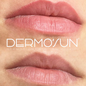 Avec le maquillage permanent des lèvres Saint-Raphaël, vous obtenez un résultat impeccable dès le réveil. Nos soins à Dermo’Sun Fréjus incluent la pigmentation contour lèvres Cannes et le voile naturel Sainte-Maxime, adaptés à chaque teint et morphologie.