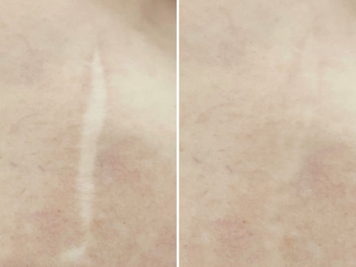Camouflage de cicatrices à Saint-Raphaël réalisé par Dermo'Sun, institut spécialisé en dermopigmentation réparatrice dans le Var. Correction esthétique naturelle des cicatrices, vergetures et marques cutanées grâce à des techniques professionnelles de pigmentation réparatrice.