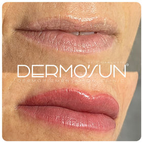 Découvrez nos réalisations de bouche effet rouge à lèvres rosé avec la technique contour et dégradé en maquillage permanent chez Dermo'Sun, spécialiste renommé en dermopigmentation à Saint-Raphaël, Fréjus, Cannes et Chantilly. Utilisation de pigments de haute qualité adaptés à votre carnation.