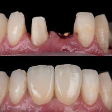 Immediate Implant for a Broken Front Tooth