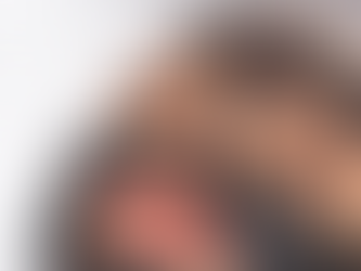 The "Black Doll" Secret: Why Sidcup is Obsessed with the Carbon Laser Facial