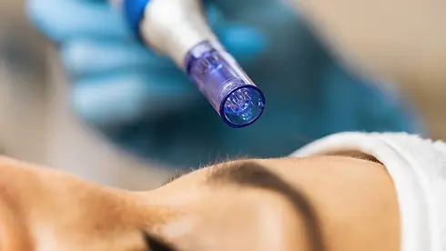 Microneedling.webp