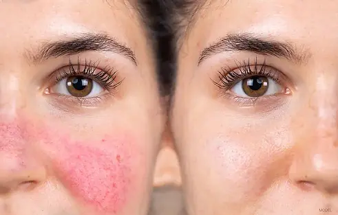 before-after-facial-redness-treatment.webp