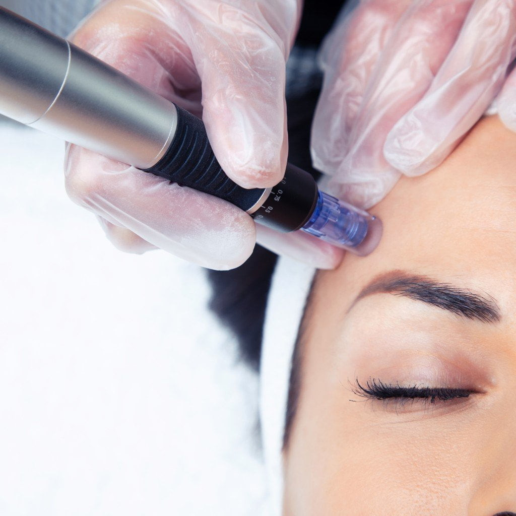 Microneedling course Worthing