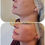 Thumbnail: Advanced Dermal Fillers academy course