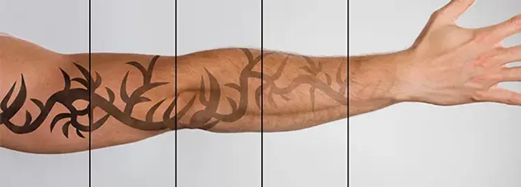 Tattoo removal bexley