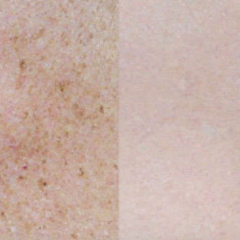 Advanced Laser Pigmentation and Skin Rejuvenation cost in Harlow
