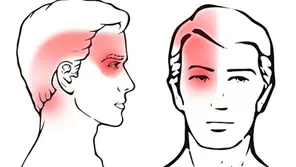 Prise en charge des céphalées cervicogéniques : rôle de l'ostéopathie et de la thérapie manuelle