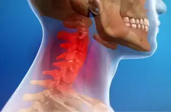 Whiplash and chronic neck pain