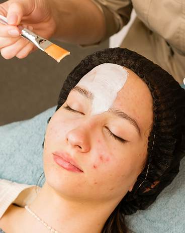 Acne Facials Calgary.png