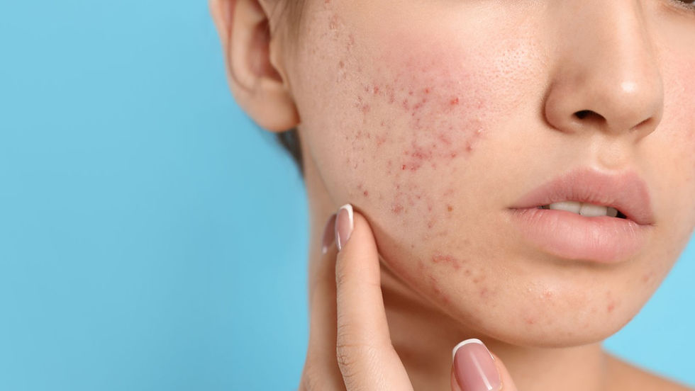 Can Facials Help with Acne? The Best Treatments for Clear Skin in Calgary
